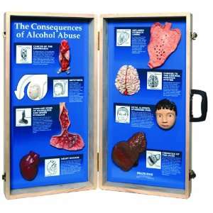 3B Scientific W43053 The Consequences of Alcohol Abuse 3D Display, 27 