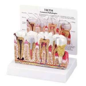 Teeth Anatomical Model; X Section of Dentition and Pathologies; On 
